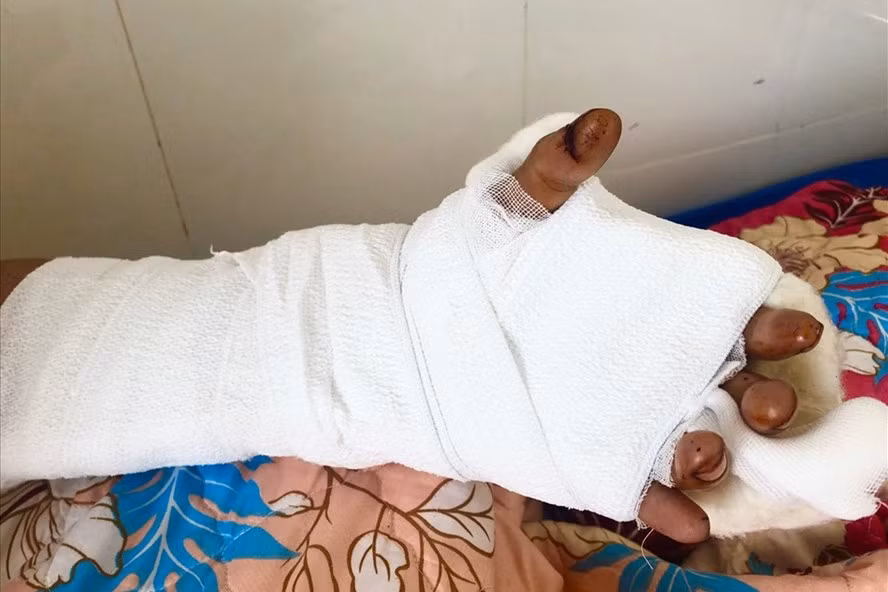 Bàn tay đứt lìa được nối thành công.