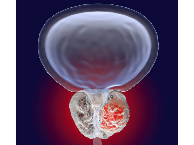 Minh họa 3D ung thư tuyến tiền liệt ẢNH: SHUTTERSTOCK