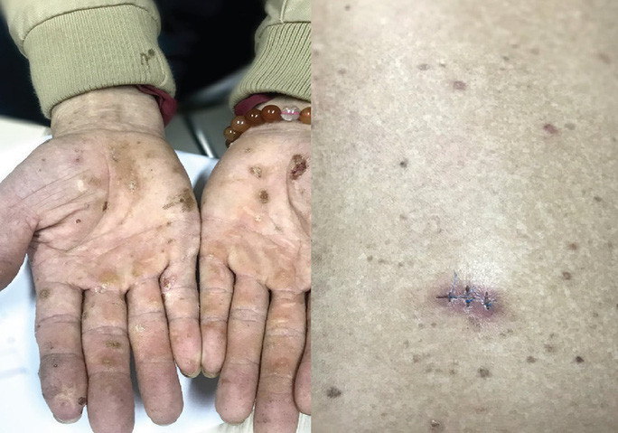 Hình ảnh dày sừng từng điểm lòng bàn tay (ảnh trái) và 