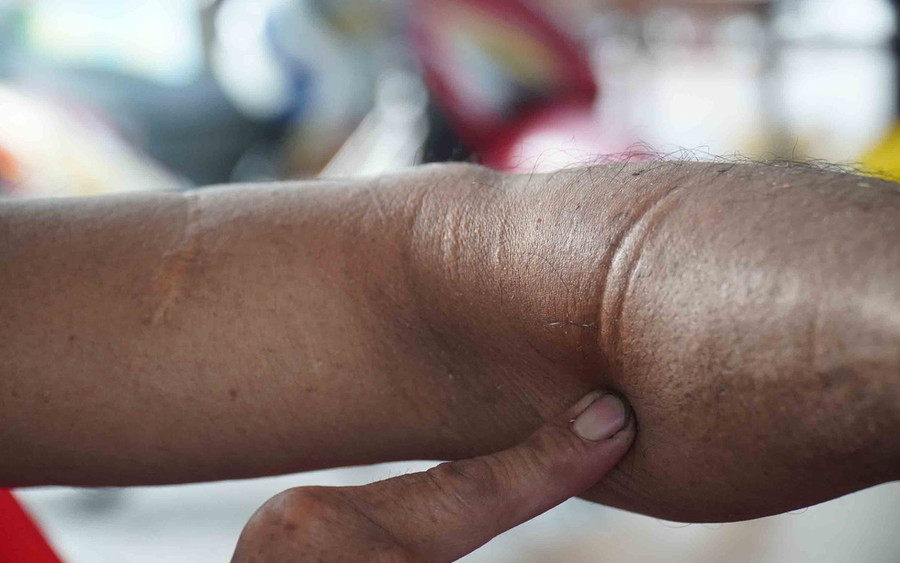  Leo trèo rất giỏi nhưng không ít lần ông bị tai nạn