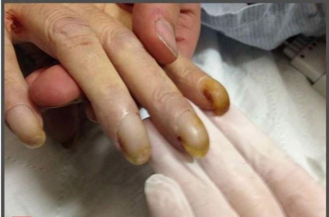 Nhiều trường hợp ung thư phổi có dấu hiệu ngón tay dùi trống ẢNH: SHUTTERSTOCK