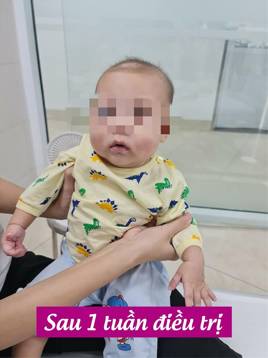 Bé trai sau 1 tuần điều trị. Ảnh: BVCC Bé trai sau 1 tuần điều trị. Ảnh: BVCC