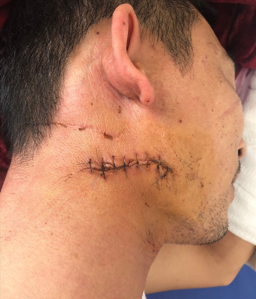 Bệnh nhân có vết thương phức tạp cổ phải và được các bác sĩ điều trị kịp thời.