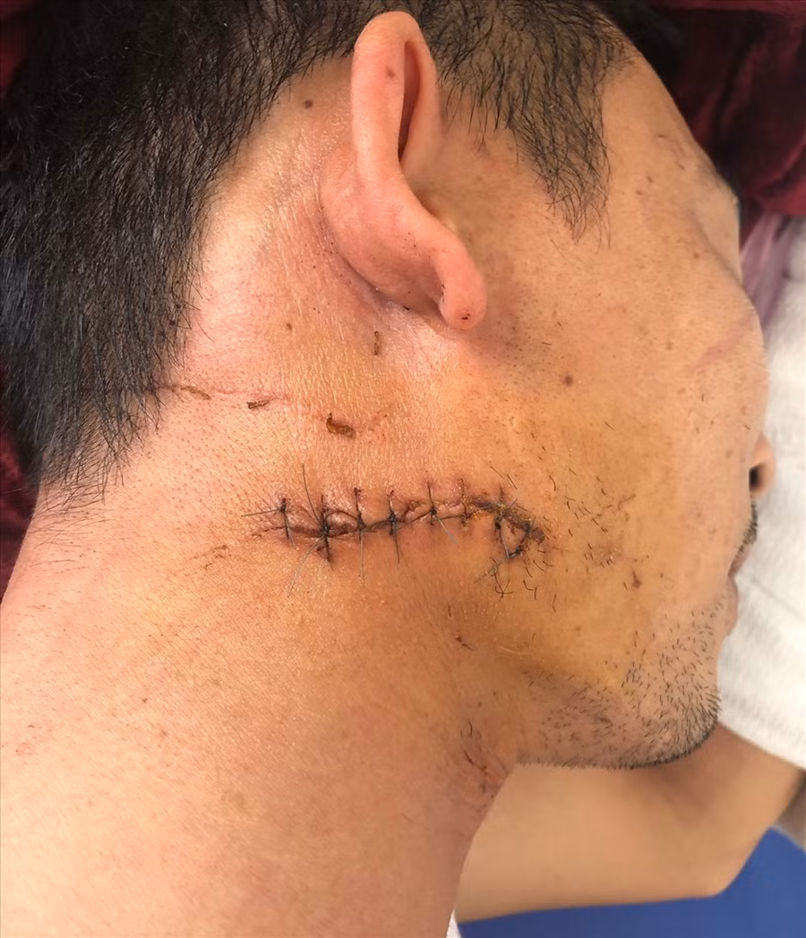 Bệnh nhân có vết thương phức tạp cổ phải và được các bác sĩ điều trị kịp thời.