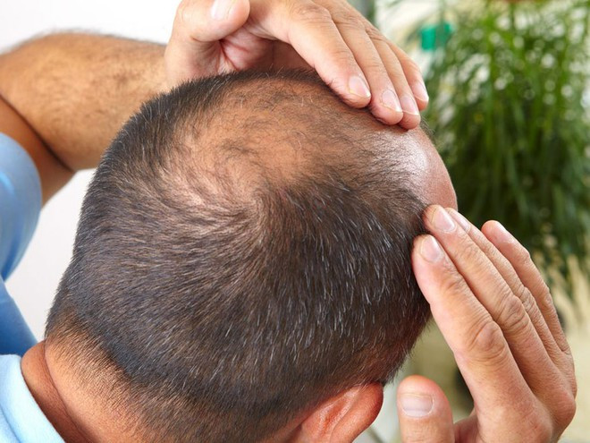 Chứng hói đầu ở đỉnh đầu làm tăng gấp đôi nguy cơ tử vong do bệnh tim ở cả hai giới ẢNH MINH HỌA: SHUTTERSTOCK