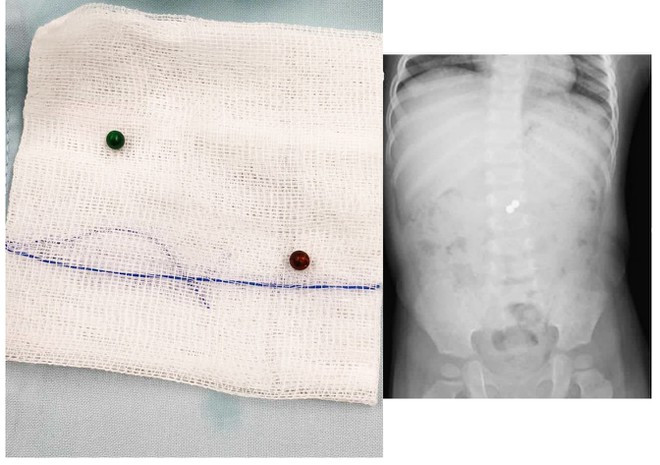 Viên bi nam châm được lấy ra ngoài và qua hình ảnh X-quang khi ở trong ruột bệnh nhi (phải) BVCC