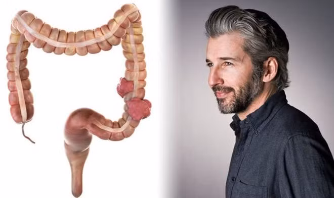 Tất cả các khối u ác tính của ruột có thể bắt đầu từ những khối u lành tính. ẢNH MINH HỌA: SHUTTERSTOCK