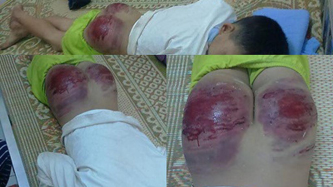 Cháu Long bị bố đẻ đánh phải nhập viện