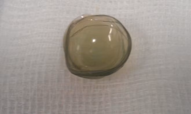  27 chiếc kính áp tròng gắn chồng lên nhau thành một lớp dày và mờ đục