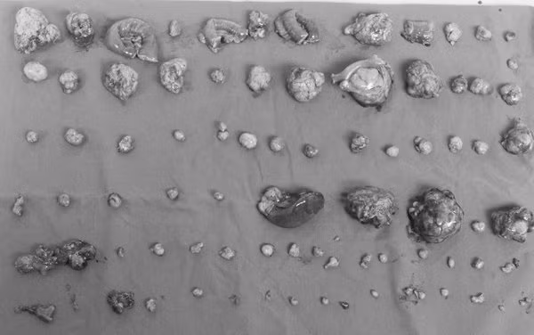 Gần 100 khối u lớn nhỏ được lấy ra