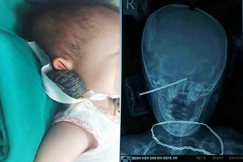 Hình ảnh cháu bé bị dị vật bằng thép đâm thủng má. Hình ảnh cháu bé bị dị vật bằng thép đâm thủng má.
