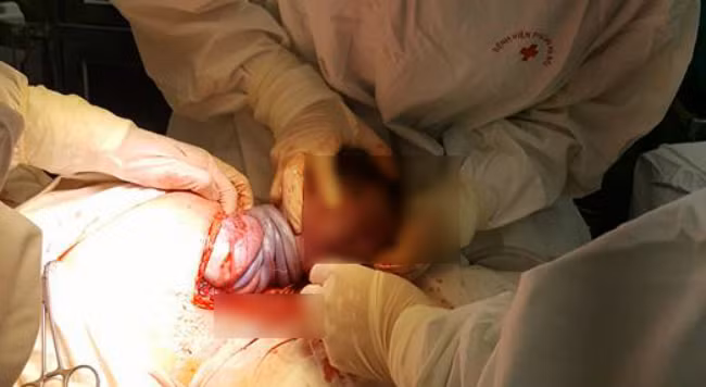 Bé trai chào đời với 4 vòng dây rốn quấn cổ hiếm gặp Bé trai chào đời với 4 vòng dây rốn quấn cổ hiếm gặp