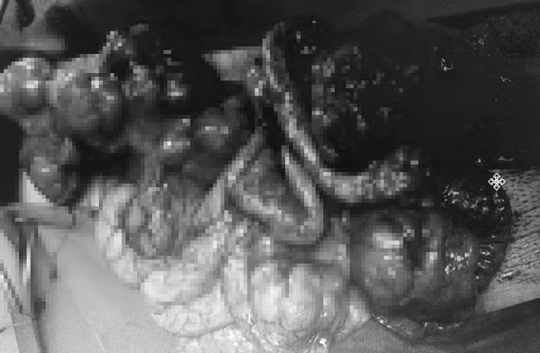 Hình ảnh ổ bụng phình to với chi chít các khối u