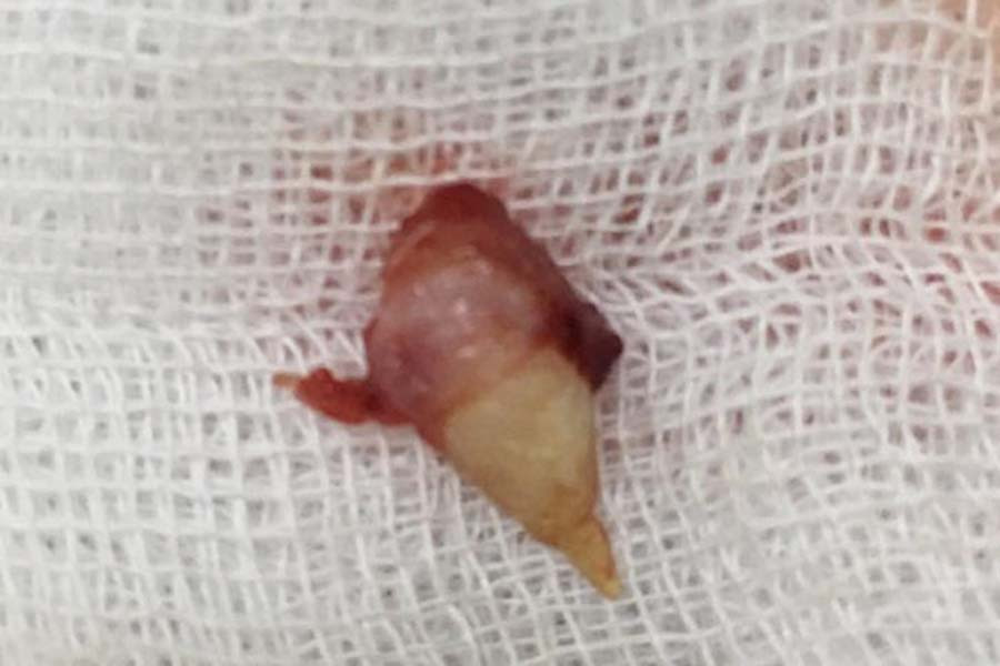 Chiếc răng được nhổ ra từ trong mũi bệnh nhân.
