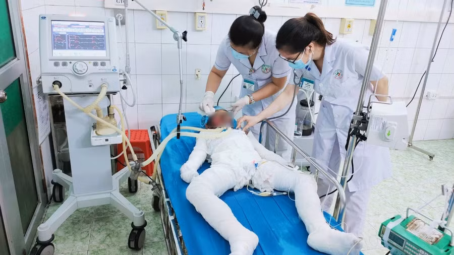 Cháu bé 7 tuổi bị bỏng nặng, đang được các bác sĩ theo dõi sát sao. Ảnh: Bệnh viện đa khoa Tuyên Quang