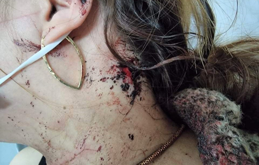 Nạn nhân bị đâm vào bên trái tai sau khi cố thoát thân bất thành. Ảnh: Trùng Dương