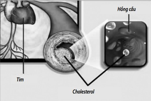 Mỡ máu cao ảnh hưởng ham muốn và khả năng tình dục