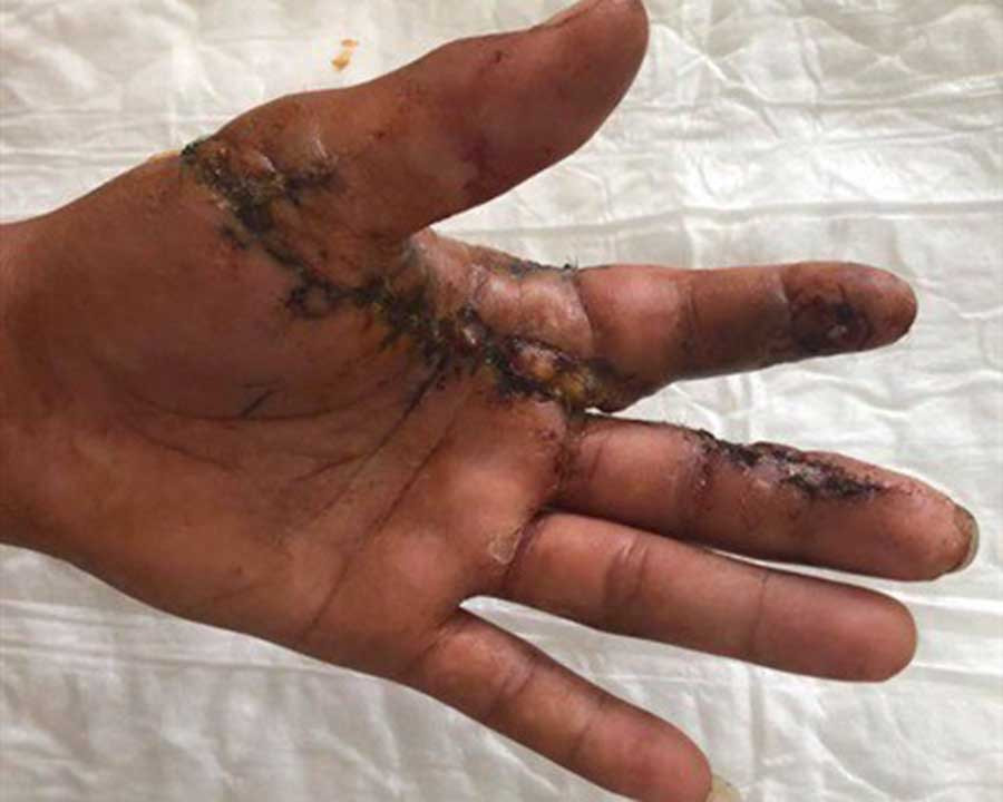  Gần nửa bàn tay của anh Khương được nối thành công sau khi bị đứt lìa