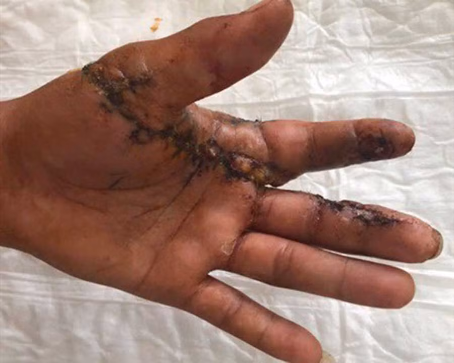  Gần nửa bàn tay của anh Khương được nối thành công sau khi bị đứt lìa