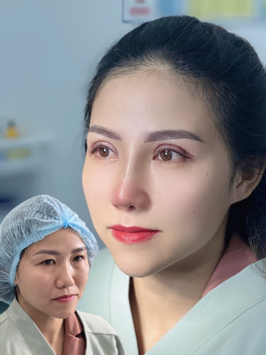 Ảnh trước và sau của một khách hàng nâng mũi, cắt mí tại Thẩm mỹ viện Quốc tế SENSE. Ảnh cơ sở cung cấp