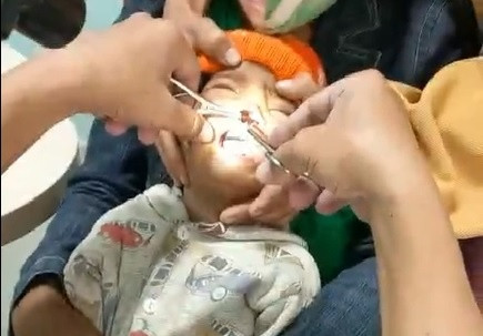 Bác sĩ tiến hành gắp con vắt sống trong khoang mũi bệnh nhi. Ảnh cắt từ clip  Bác sĩ tiến hành gắp con vắt sống trong khoang mũi bệnh nhi. Ảnh cắt từ clip