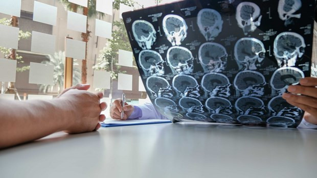 Công nghệ dựa trên trí tuệ nhân tạo (AI) đã giúp tăng đáng kể hiệu quả chữa trị bệnh nhân đột quỵ tại Anh. Nguồn: Open Access News