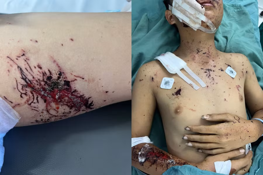 Bệnh nhi 12 tuổi bị đa chấn thương khi tự chế pháo. Ảnh: D.T