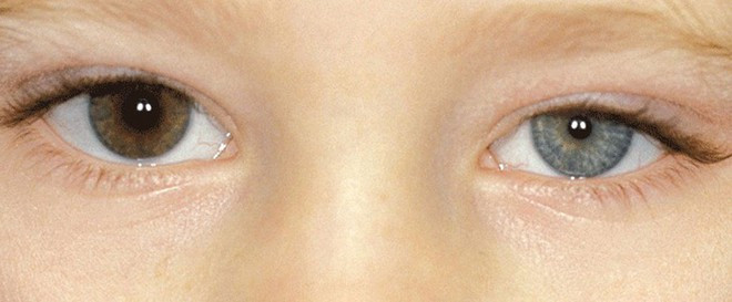 Các khối u ở phần trên của phổi cũng có thể ảnh hưởng đến các dây thần kinh đến mắt và một phần khuôn mặt, khiến đồng tử của một mắt nhỏ hơn và mí mắt sụp xuống, nhìn mờ ẢNH MINH HỌA: SHUTTERSTOCK