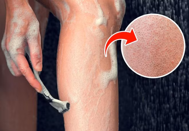 Cạo bằng dao cạo cũ hoặc không thoa kem, có thể khiến da bị kích ứng, vùng da xung quanh nang lông sẫm màu và xuất hiện các chấm đen trên da ẢNH MINH HỌA: SHUTTERSTOCK