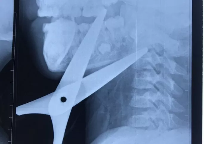 Hình ảnh dị vật qua phim chụp