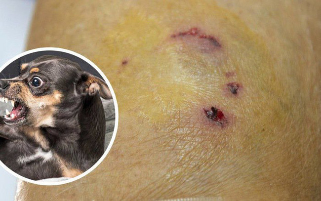 Dại là bệnh viêm não tủy cấp tính do virus, nếu không tiêm huyết thanh kháng dại sau khi bị chó cắn chắc chắn tử vong lúc lên cơn.