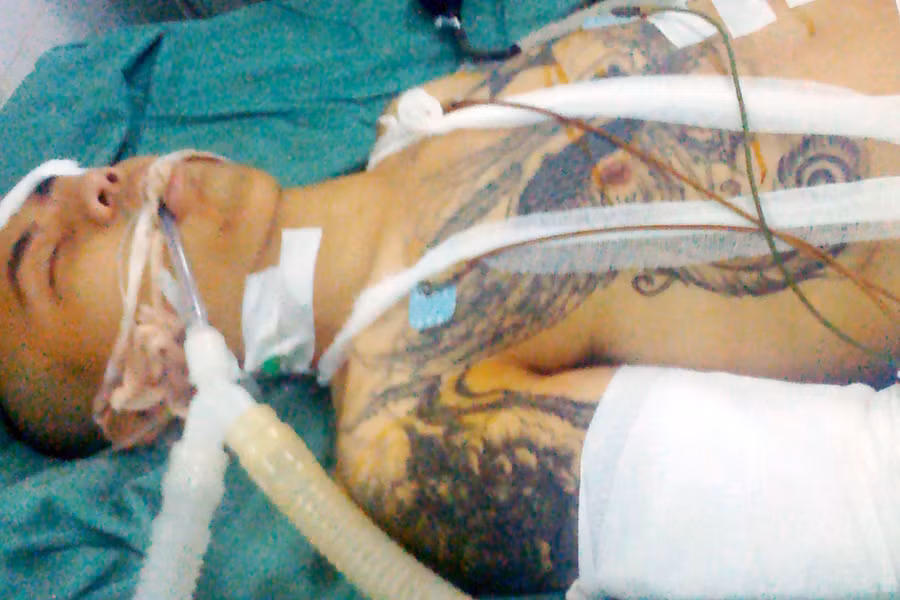 Nạn nhân Nguyễn Phạm Văn Trường đang được điều trị tại Bệnh viện Đa Khoa tỉnh Kon Tum. Ảnh: Na Dương