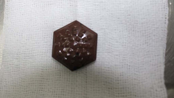 Dị vật có cạnh, góc sắc nhọn được lấy ra trong đường tiêu hóa của nam bệnh nhân 53 tuổi 