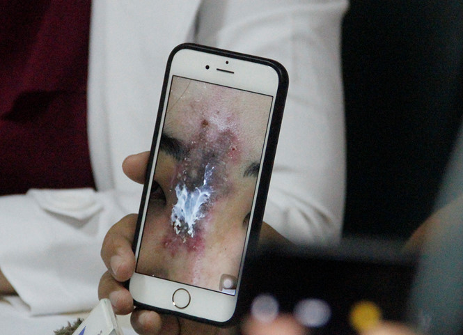 Phần mũi bị hoại tử của bệnh nhân Phần mũi bị hoại tử của bệnh nhân