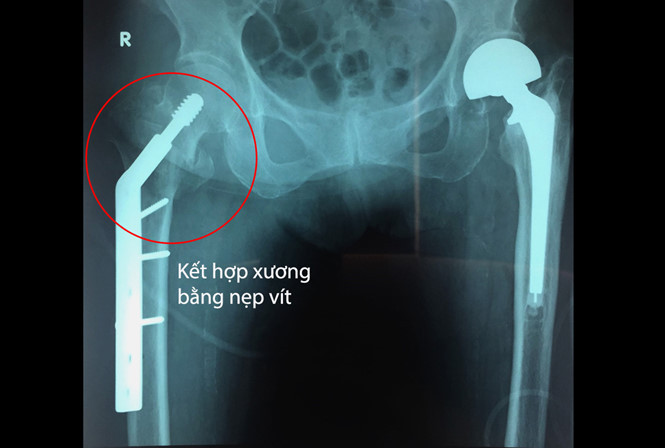  Vị trí xương gãy được kết hợp bằng nẹp vít