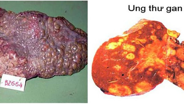Hình ảnh gan bị các khối ung thư xâm chiếm