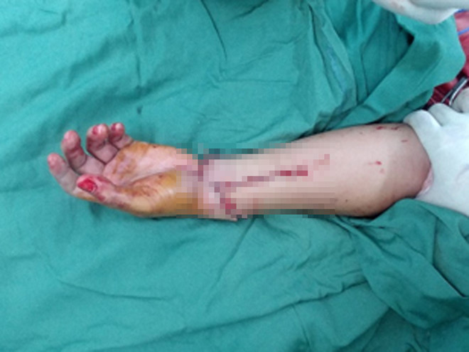 Bệnh nhân được nối cánh tay đứt lìa tại Viện Chấn thương chỉnh hình 175 (TP.HCM) ẢNH: BS CUNG CẤP