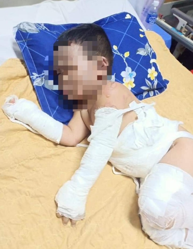 Cháu bé đang điều trị bỏng nặng Cháu bé đang điều trị bỏng nặng