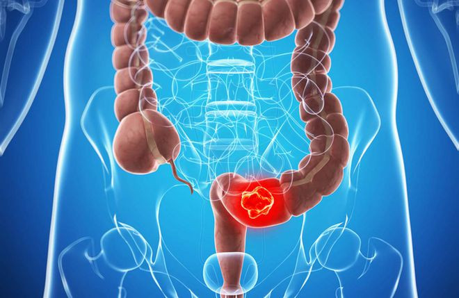 Tiêu thụ 2 gram chiết xuất gừng mỗi ngày giúp giảm nguy cơ ung thư đại tràng. ẢNH: SHUTTERSTOCK