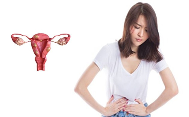 U xơ tử cung gây triệu chứng đau dữ dội trong kỳ kinh nguyệt. Đồ họa: Hồng Nhật