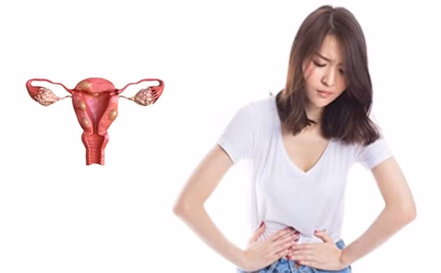 U xơ tử cung gây triệu chứng đau dữ dội trong kỳ kinh nguyệt. Đồ họa: Hồng Nhật