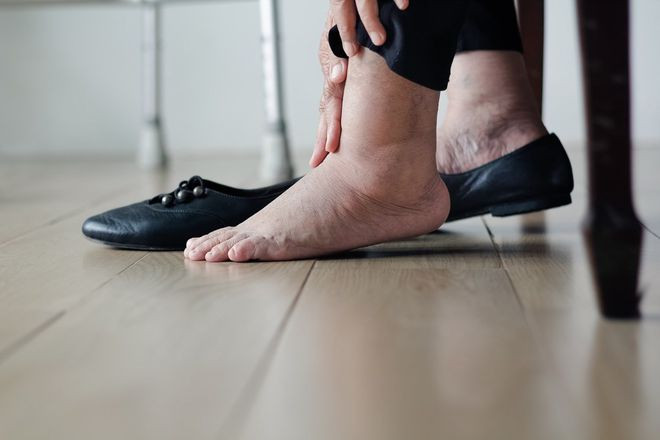 Người bệnh có thể bị sưng phù mặt, chân, mắt cá và bàn chân nếu bị viêm gan mạn tính ẢNH: SHUTTERSTOCK
