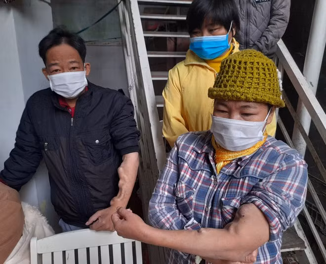 Những cánh tay biến dạng do chạy thận nhân tạo lâu năm