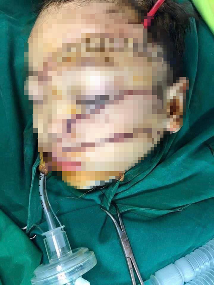 Xót xa hình ảnh cháu K nghi bị cha chém 3 nhát dài trên mặt Xót xa hình ảnh cháu K nghi bị cha chém 3 nhát dài trên mặt