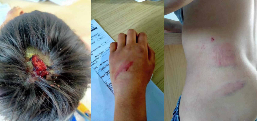 Những vết thương trên cơ thể cháu Boy. Ảnh: Gia đình cung cấp