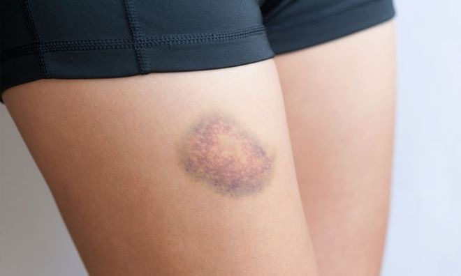 Người bị viêm gan C giai đoạn nặng, sẽ dễ bị bầm tím và chảy máu. ẢNH: SHUTTERSTOCK