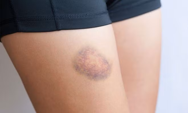 Người bị viêm gan C giai đoạn nặng, sẽ dễ bị bầm tím và chảy máu. ẢNH: SHUTTERSTOCK