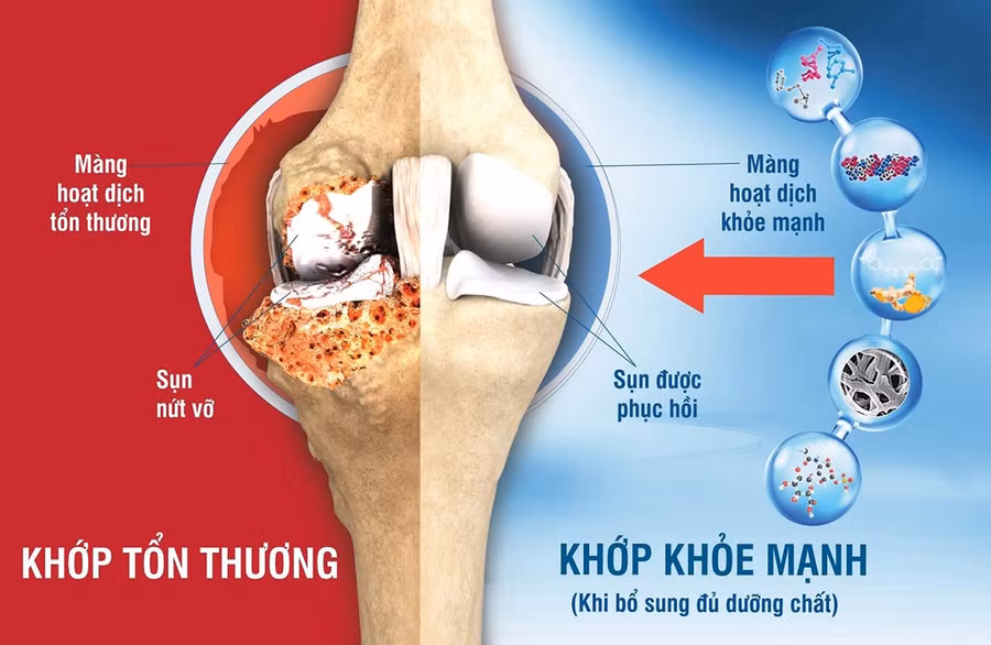 Khớp đau nhức, thoái hóa là bởi sụn và màng hoạt dịch bị tổn thương. Ảnh: Eco Green