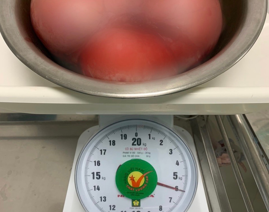  Theo các phẫu thuật viên, đây là trường hợp có khối u xơ tử cung kích thước lớn nhất từng được phẫu thuật tại Bệnh viện đa khoa Trung ương Cần Thơ. Ảnh: Đình Tuyển