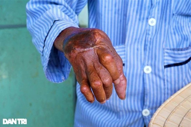 Tay của ông Ngọc bị thương trong chiến tranh, mỗi khi trái gió trở trời thì rất đau nhức.